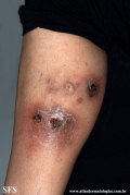 granuloma annulare-perforanting granuloma annulare