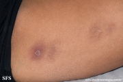 granuloma annulare-perforanting granuloma annulare