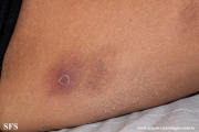 granuloma annulare-perforanting granuloma annulare