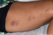 granuloma annulare-perforanting granuloma annulare