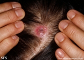 cyst-ruptured_cyst