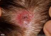 cyst-ruptured_cyst