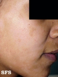 pityriasis alba