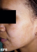 pityriasis alba