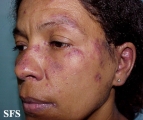 lupus erythematosus-subacute cutaneous lupus erythematosus