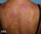 lupus erythematosus-subacute cutaneous lupus erythematosus