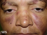lupus erythematosus-subacute cutaneous lupus erythematosus