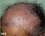 lupus erythematosus-subacute cutaneous lupus erythematosus