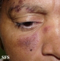 lupus erythematosus-subacute cutaneous lupus erythematosus