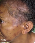 lupus erythematosus-subacute cutaneous lupus erythematosus