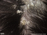 pityriasis amiantacea