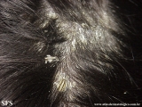 pityriasis amiantacea