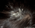 pityriasis amiantacea