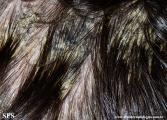pityriasis amiantacea