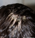 pityriasis amiantacea
