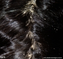 pityriasis amiantacea