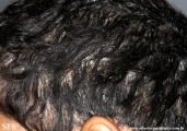 pityriasis amiantacea