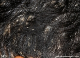 pityriasis amiantacea