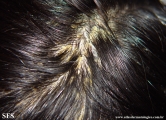 pityriasis amiantacea