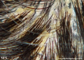 pityriasis amiantacea