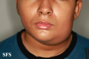 parotitis