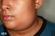 parotitis