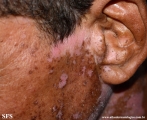 psoriasis_and_vitiligo