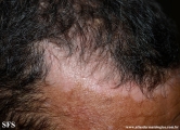psoriasis_and_vitiligo