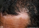 psoriasis_and_vitiligo