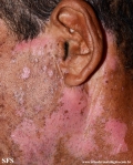 psoriasis_and_vitiligo