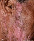 psoriasis_and_vitiligo