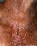 psoriasis_and_vitiligo