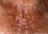 psoriasis_and_vitiligo