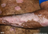 psoriasis_and_vitiligo