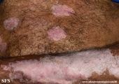 psoriasis_and_vitiligo