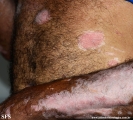 psoriasis_and_vitiligo
