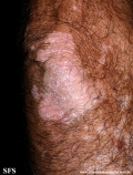 psoriasis_and_vitiligo