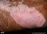 psoriasis_and_vitiligo