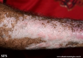 psoriasis_and_vitiligo