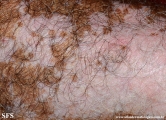 psoriasis_and_vitiligo