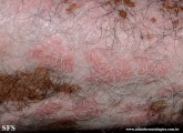 psoriasis_and_vitiligo