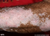 psoriasis_and_vitiligo
