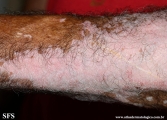 psoriasis_and_vitiligo