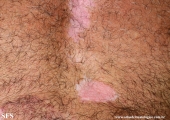 psoriasis_and_vitiligo