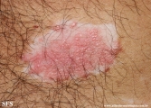 psoriasis_and_vitiligo