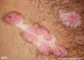 psoriasis_and_vitiligo