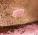 psoriasis_and_vitiligo