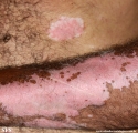 psoriasis_and_vitiligo