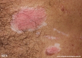 psoriasis_and_vitiligo