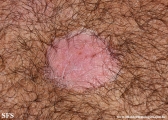 psoriasis_and_vitiligo